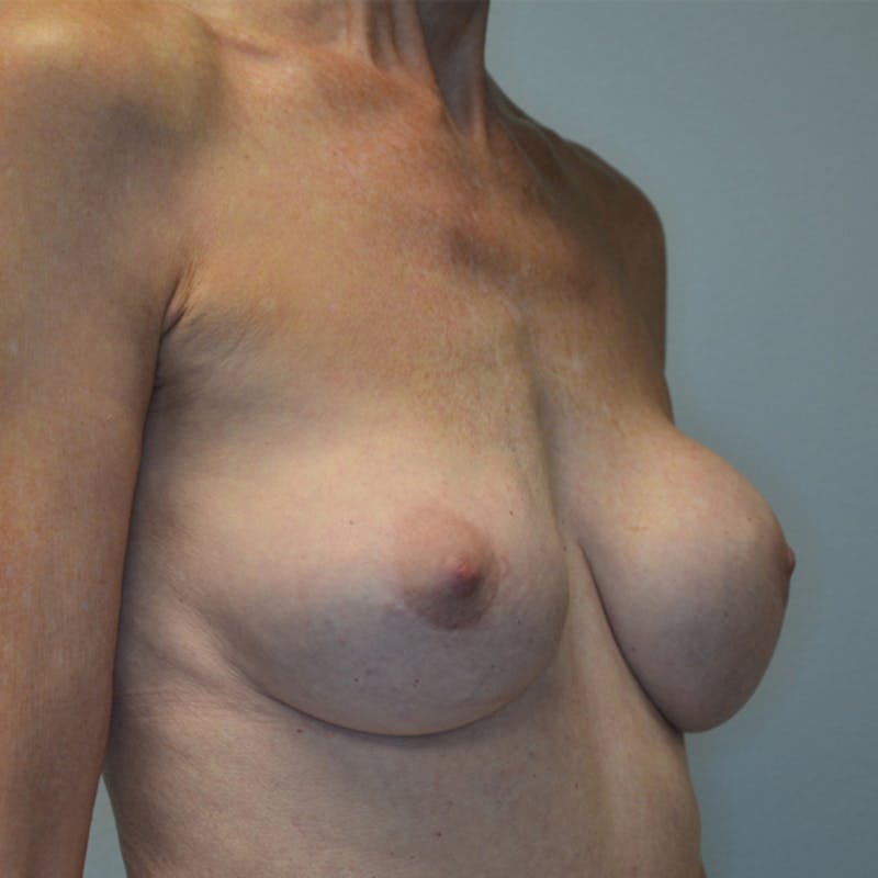 Breast Revision Before & After Gallery - Patient 115351824 - Image 3