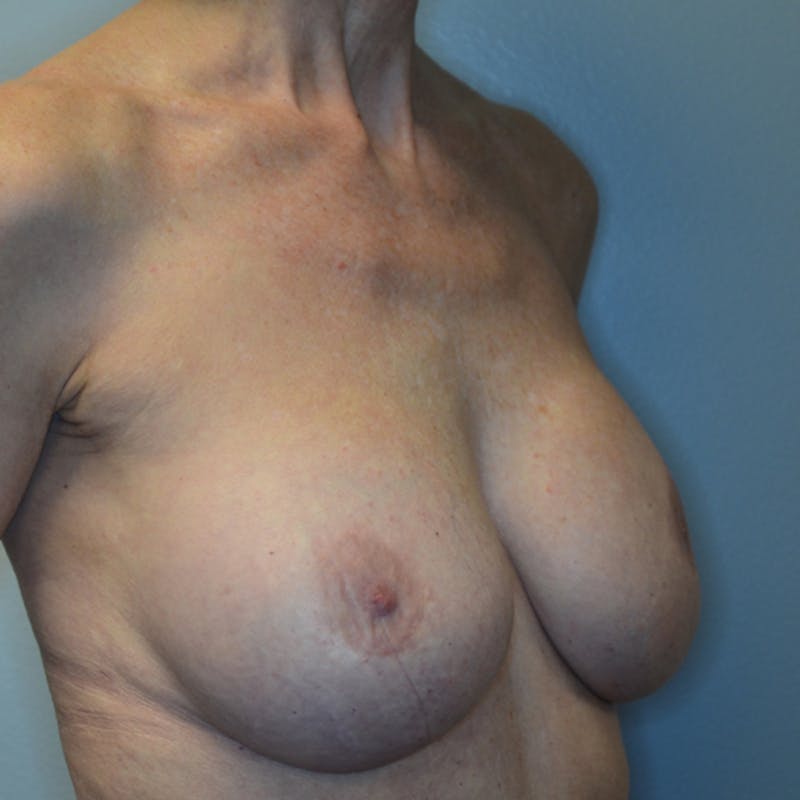 Breast Revision Before & After Gallery - Patient 115351824 - Image 4