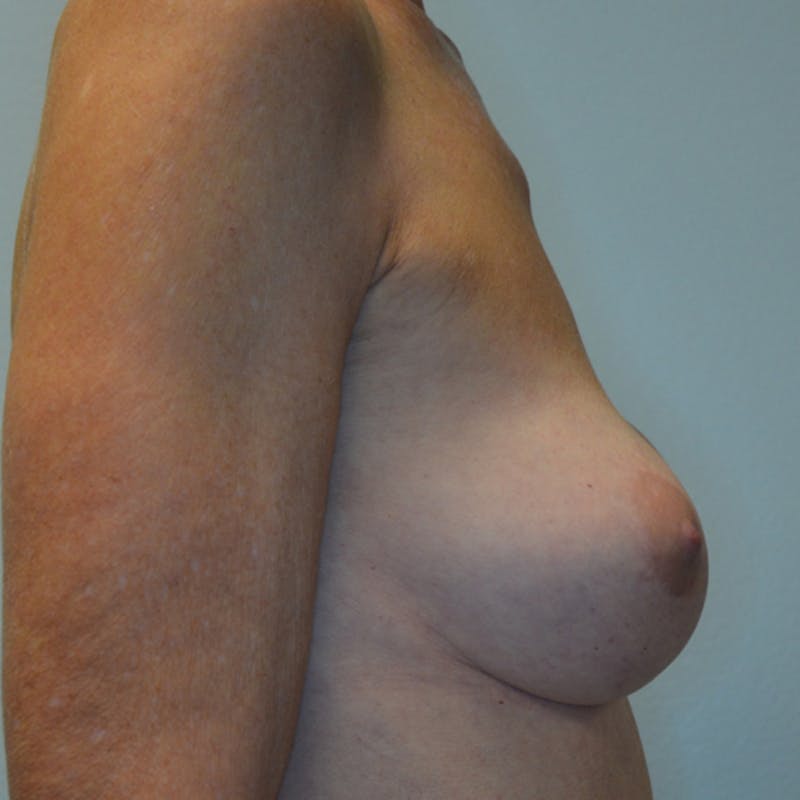 Breast Revision Before & After Gallery - Patient 115351824 - Image 5