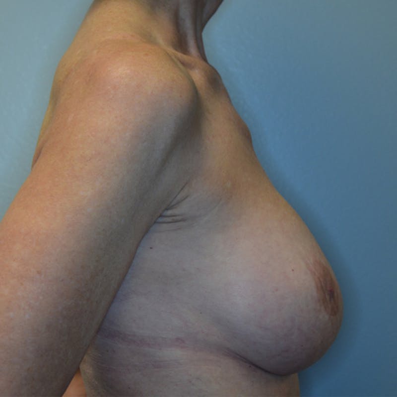 Breast Revision Before & After Gallery - Patient 115351824 - Image 6