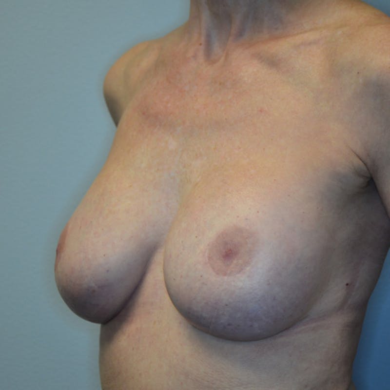 Breast Revision Before & After Gallery - Patient 115351824 - Image 8