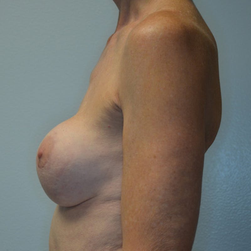 Breast Revision Before & After Gallery - Patient 115351824 - Image 9