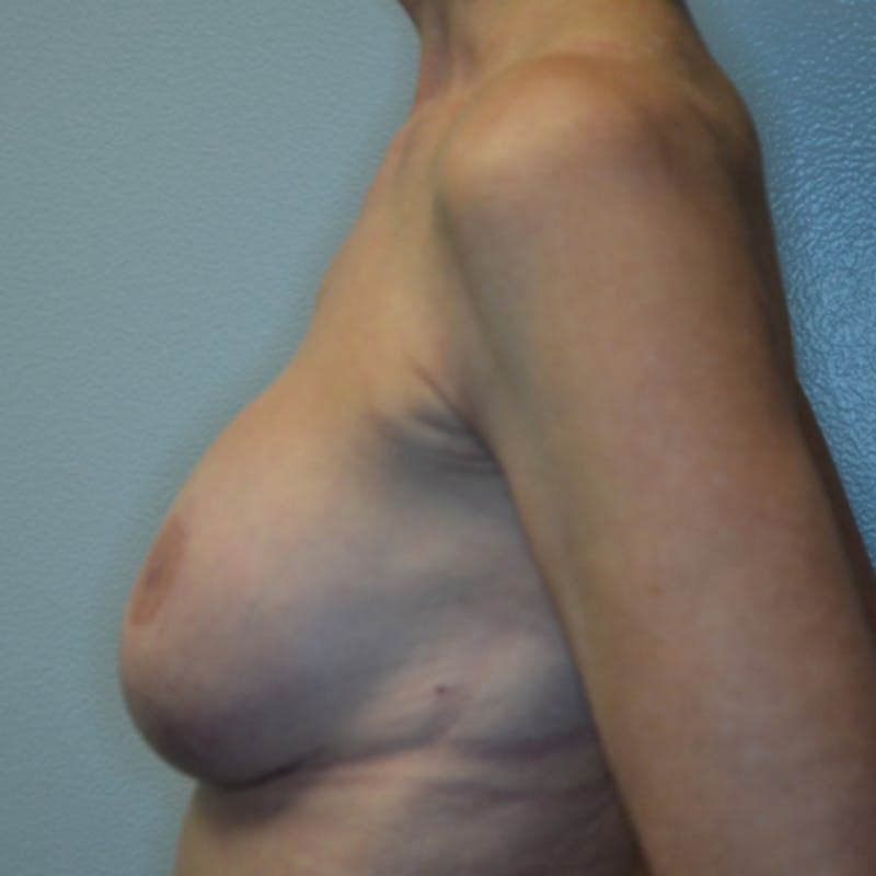 Breast Revision Before & After Gallery - Patient 115351824 - Image 10