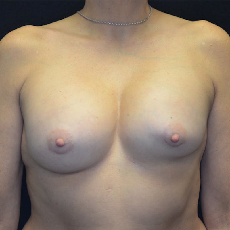 Breast Revision Before & After Gallery - Patient 115351833 - Image 1