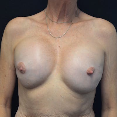 Breast Revision Before & After Gallery - Patient 115351840 - Image 1