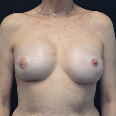 Breast Revision Before & After Gallery - Patient 115351840 - Image 2