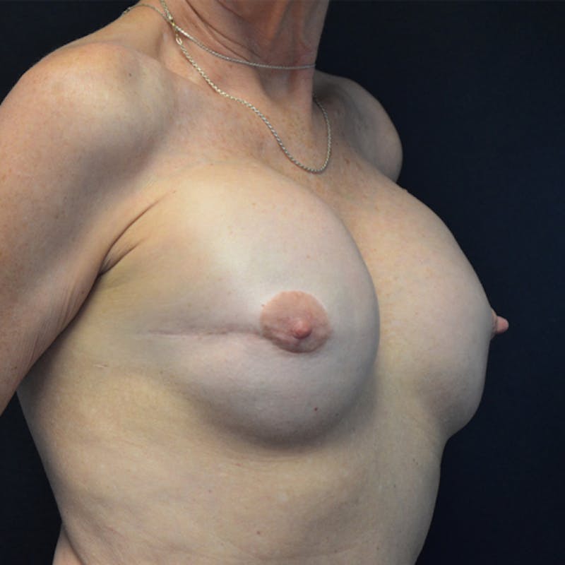 Breast Revision Before & After Gallery - Patient 115351840 - Image 3