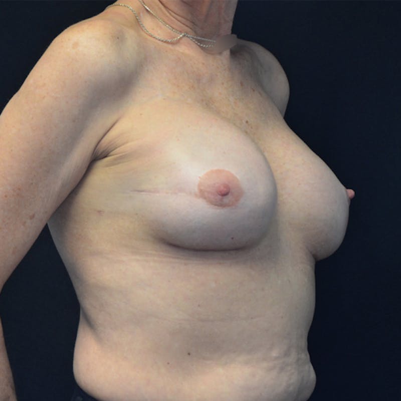 Breast Revision Before & After Gallery - Patient 115351840 - Image 4