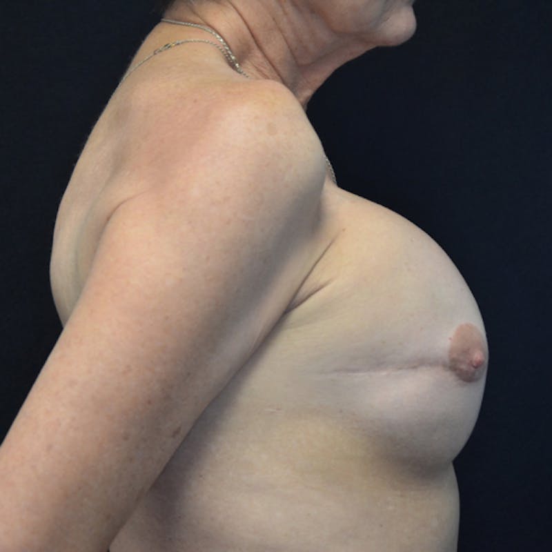 Breast Revision Before & After Gallery - Patient 115351840 - Image 5