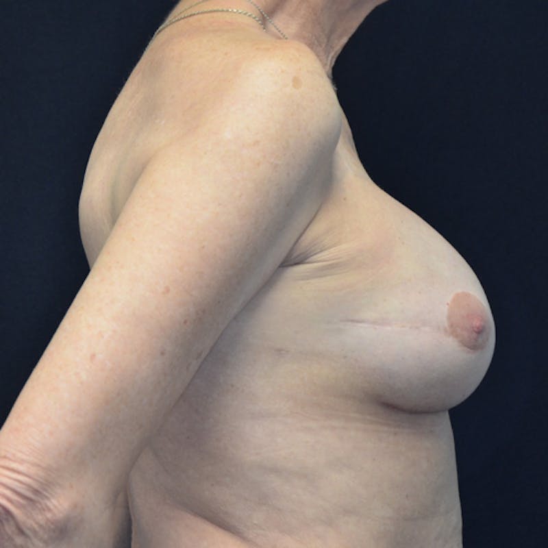 Breast Revision Before & After Gallery - Patient 115351840 - Image 6