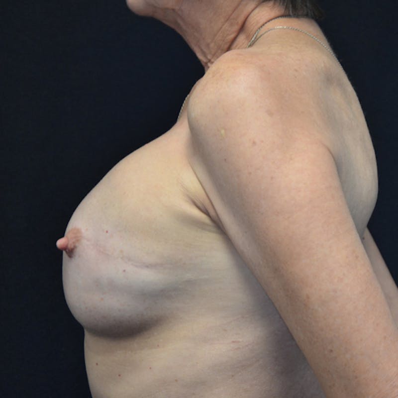 Breast Revision Before & After Gallery - Patient 115351840 - Image 9