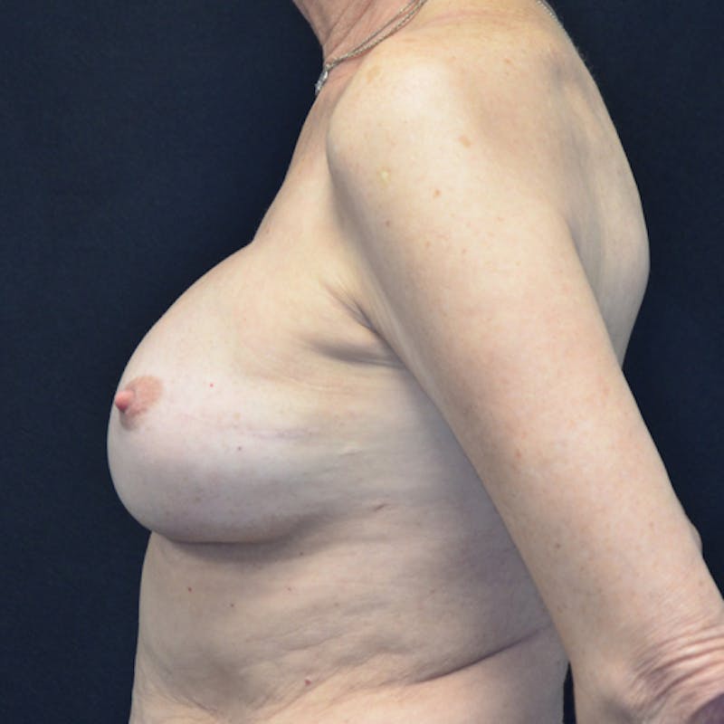 Breast Revision Before & After Gallery - Patient 115351840 - Image 10