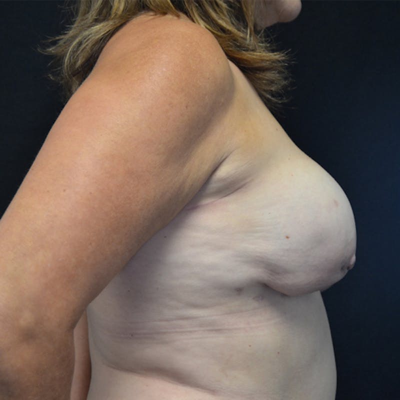 Breast Revision Before & After Gallery - Patient 115351849 - Image 5