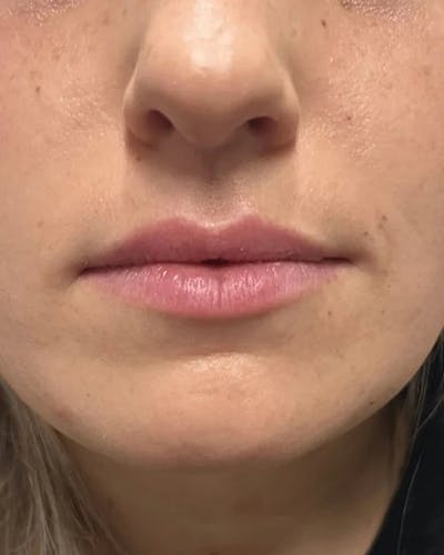 Dermal Fillers Before & After Gallery - Patient 115362777 - Image 1