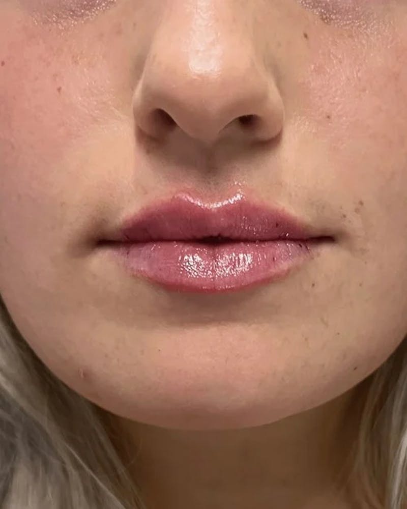 Dermal Fillers Before & After Gallery - Patient 115362777 - Image 2