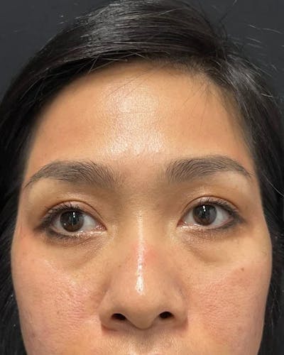 Dermal Fillers Before & After Gallery - Patient 115362779 - Image 1