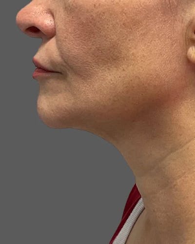 SkinTyte Before & After Gallery - Patient 135342354 - Image 2