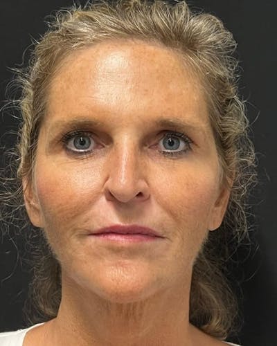 HALO™ Laser Treatment Before & After Gallery - Patient 115363010 - Image 1