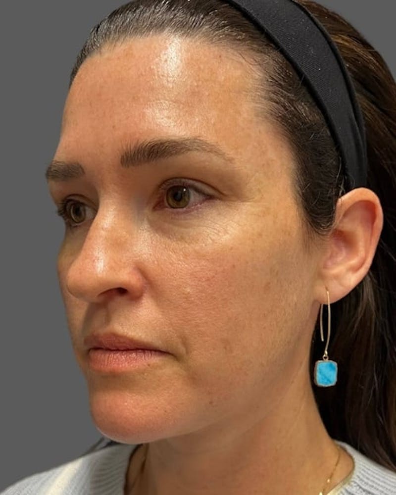 HALO™ Laser Treatment Before & After Gallery - Patient 115363009 - Image 1