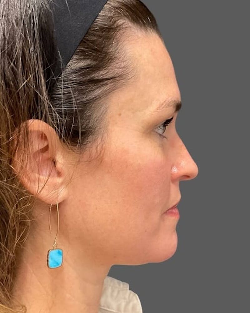HALO™ Laser Treatment Before & After Gallery - Patient 115363009 - Image 4