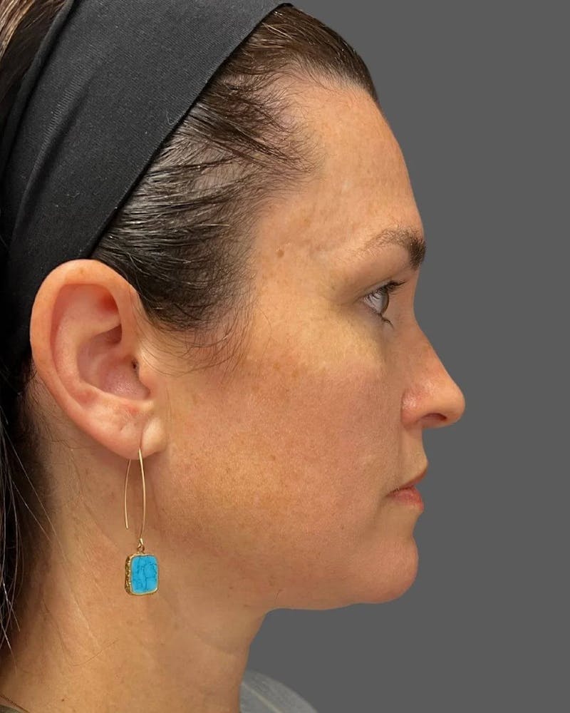 HALO™ Laser Treatment Before & After Gallery - Patient 115363009 - Image 3