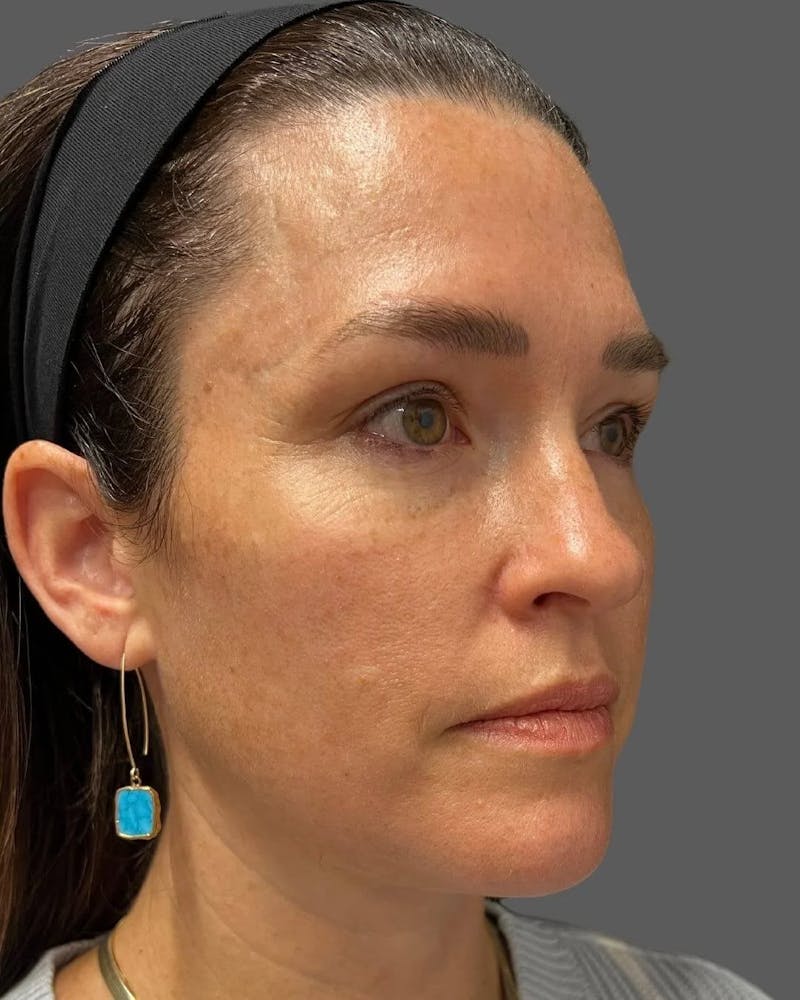 HALO™ Laser Treatment Before & After Gallery - Patient 115363009 - Image 5