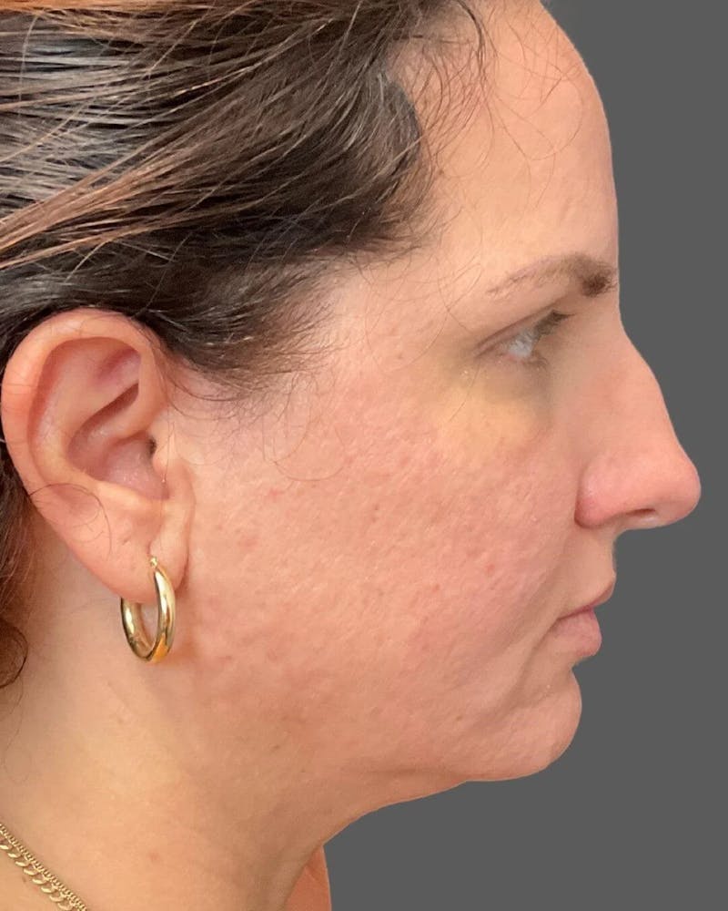 HALO™ Laser Treatment Before & After Gallery - Patient 115363007 - Image 4