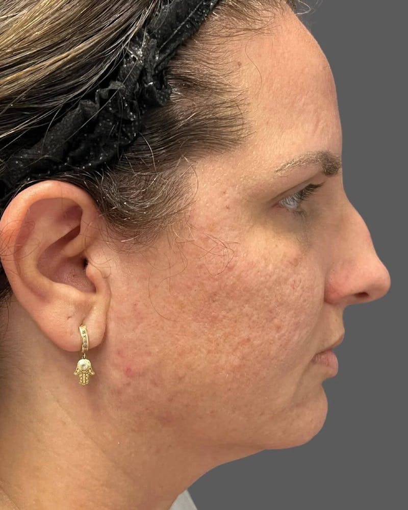 HALO™ Laser Treatment Before & After Gallery - Patient 115363007 - Image 3
