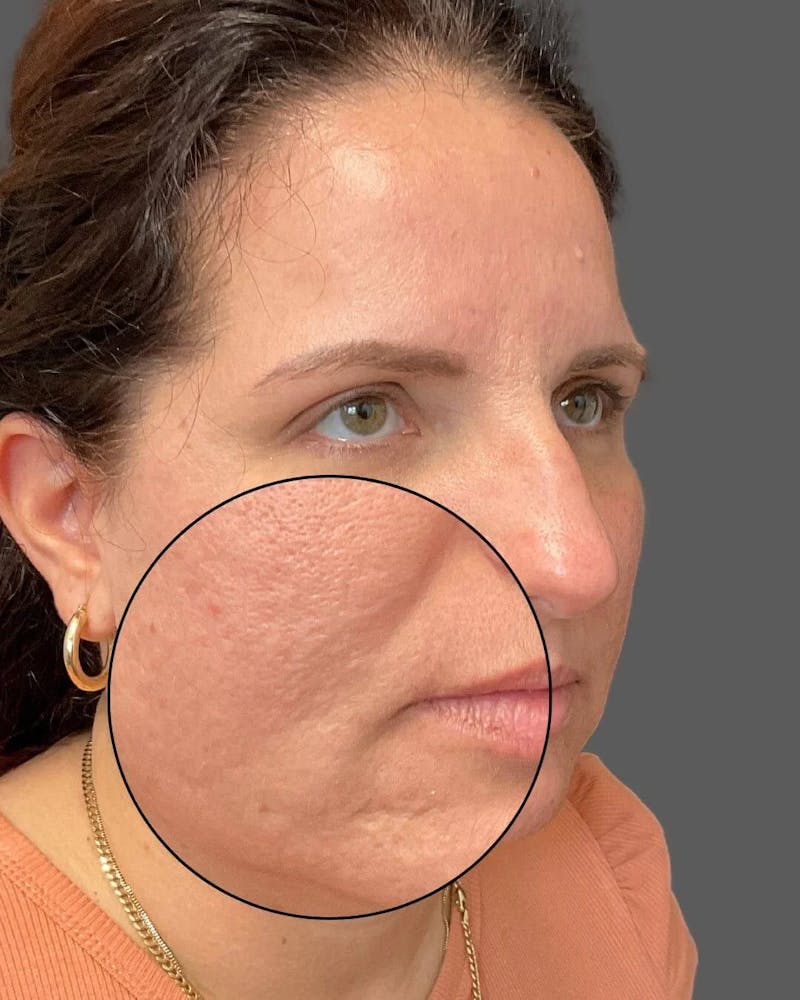 HALO™ Laser Treatment Before & After Gallery - Patient 115363007 - Image 6
