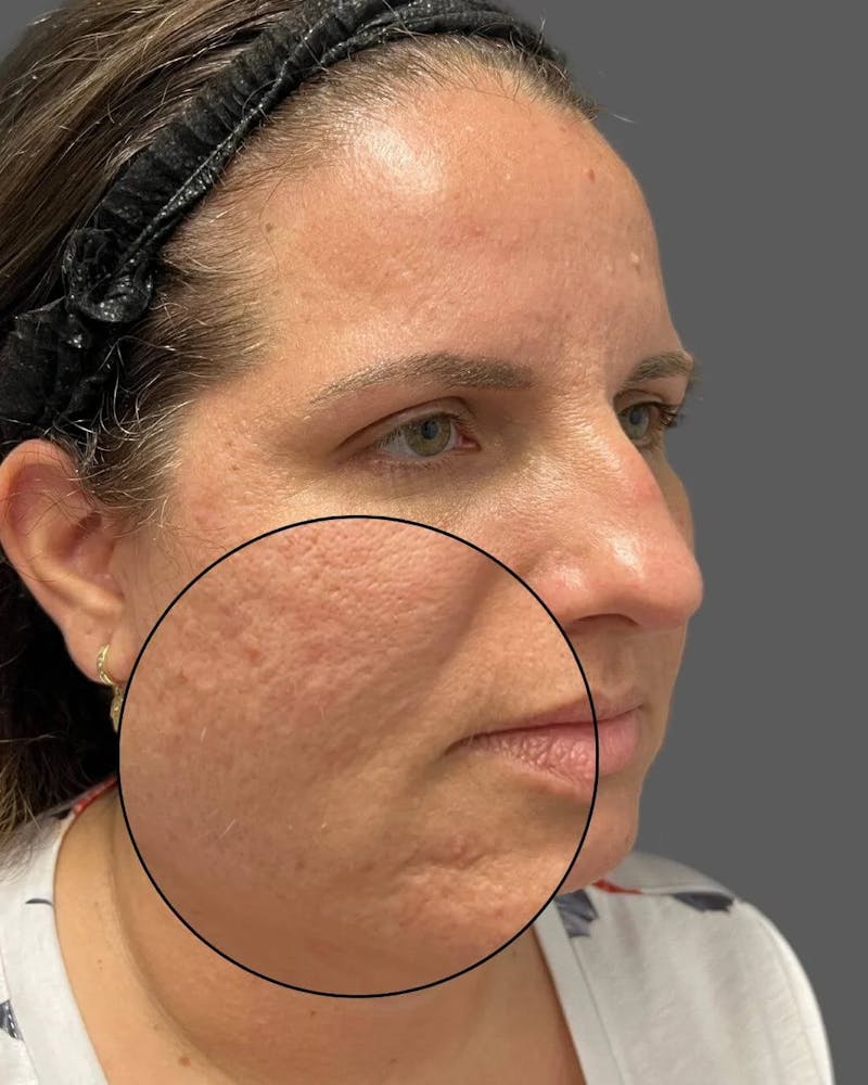 HALO™ Laser Treatment Before & After Gallery - Patient 115363007 - Image 5