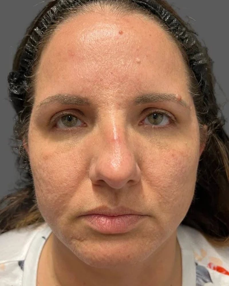 HALO™ Laser Treatment Before & After Gallery - Patient 115363007 - Image 1