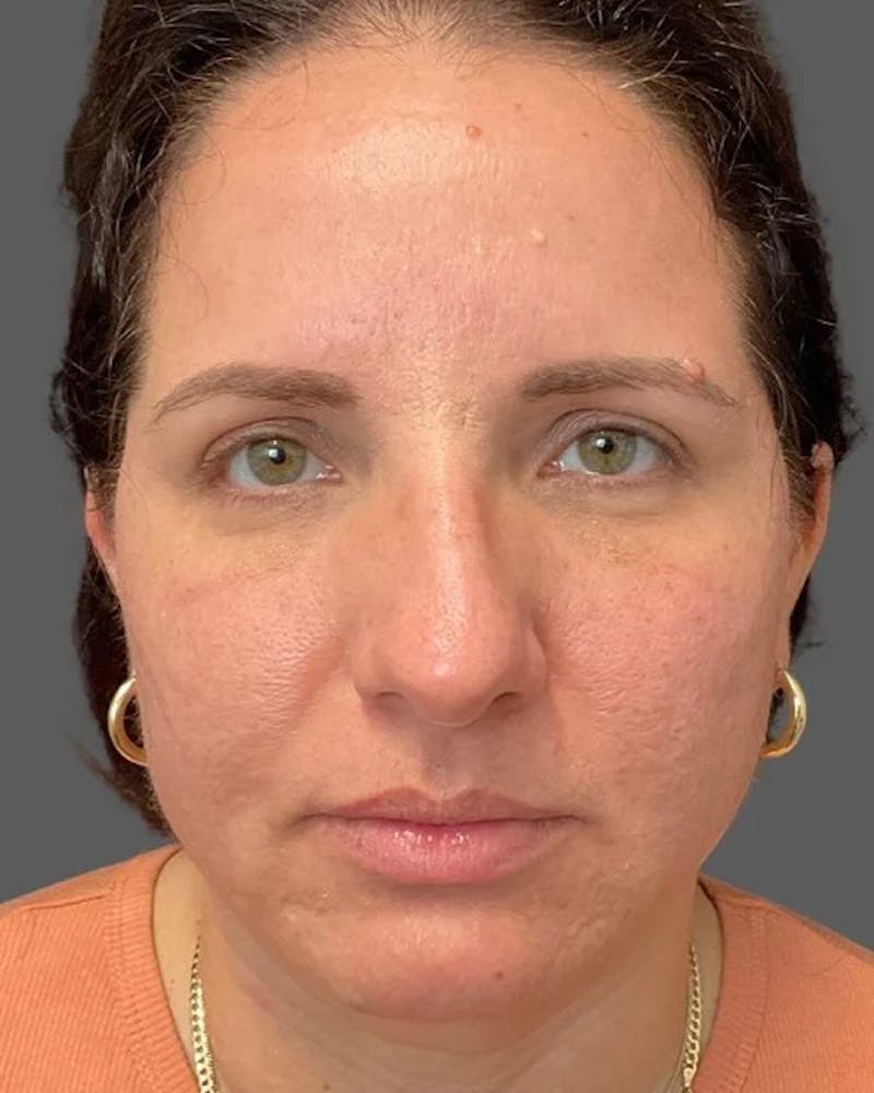 HALO™ Laser Treatment Before & After Gallery - Patient 115363007 - Image 2