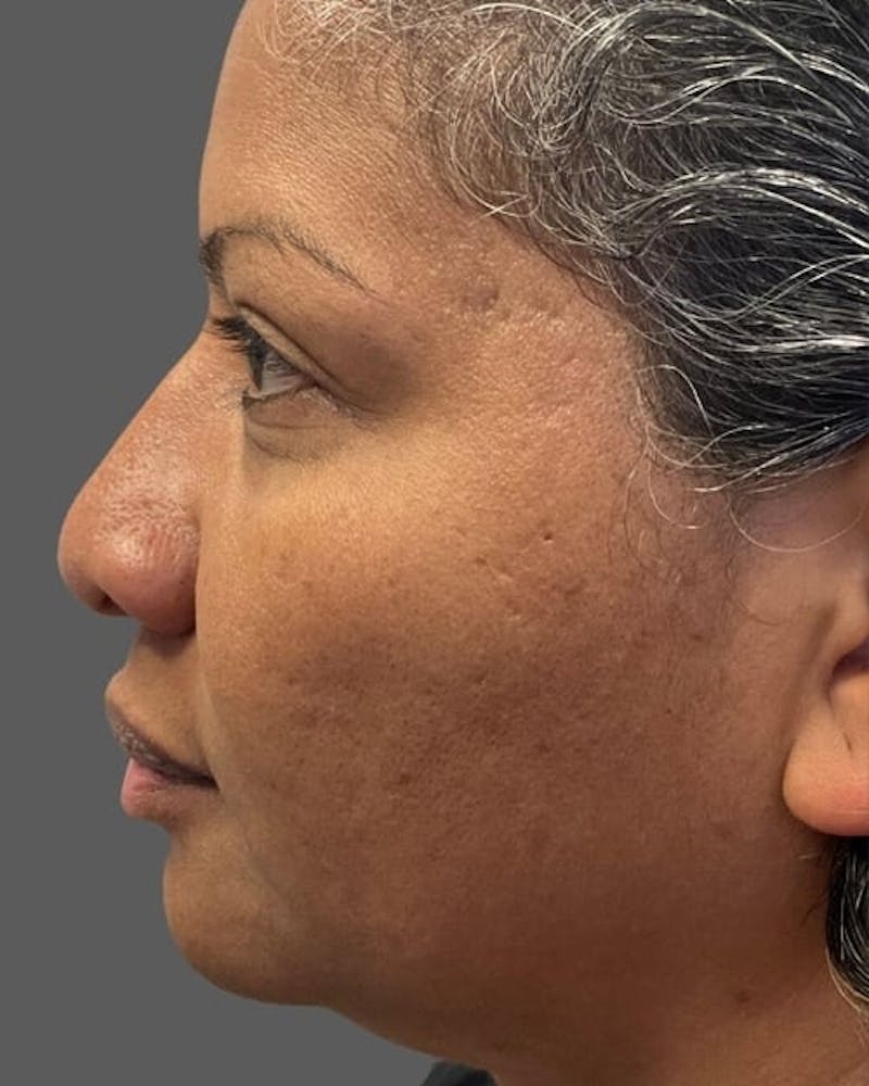 HALO™ Laser Treatment Before & After Gallery - Patient 115363008 - Image 5