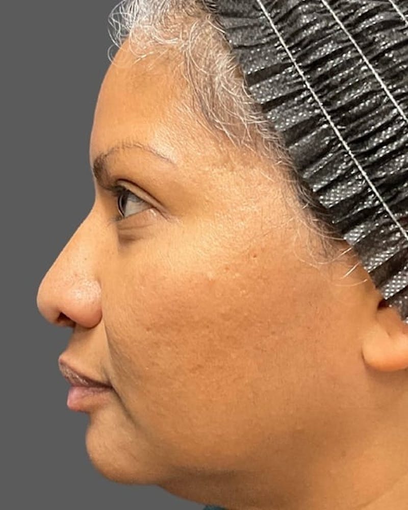 HALO™ Laser Treatment Before & After Gallery - Patient 115363008 - Image 6