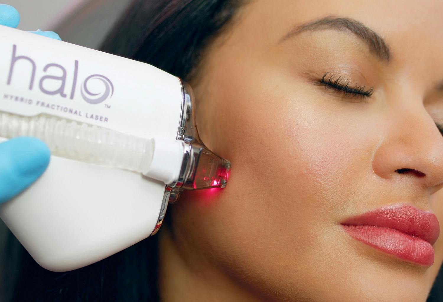Woman Receiving Halo Laser Treatment