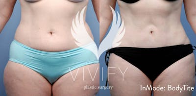 Bodytite By Inmode Before & After Gallery - Patient 122265035 - Image 1