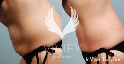 Bodytite By Inmode Before & After Gallery - Patient 122265038 - Image 1