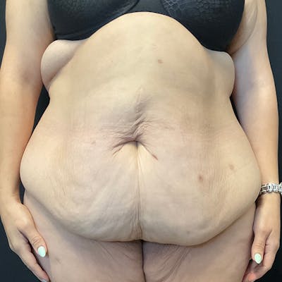Body Lift Before & After Gallery - Patient 172844959 - Image 1