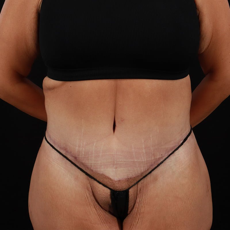 Body Lift Before & After Gallery - Patient 172844959 - Image 2