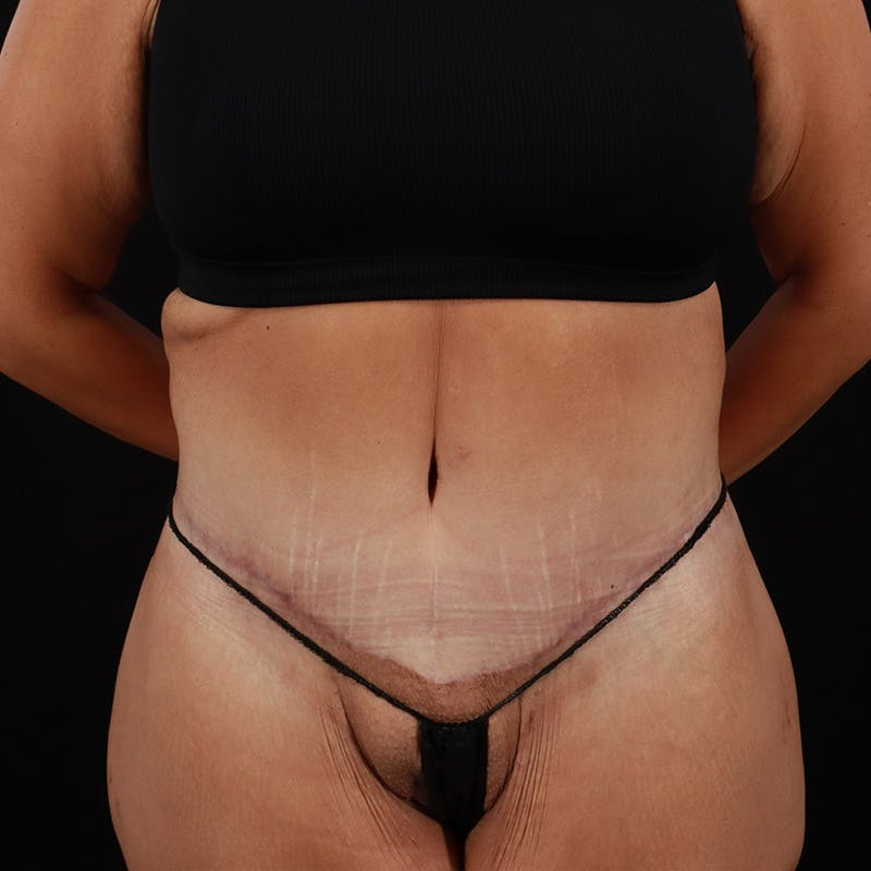 Body Lift Before & After Gallery - Patient 172844959 - Image 2