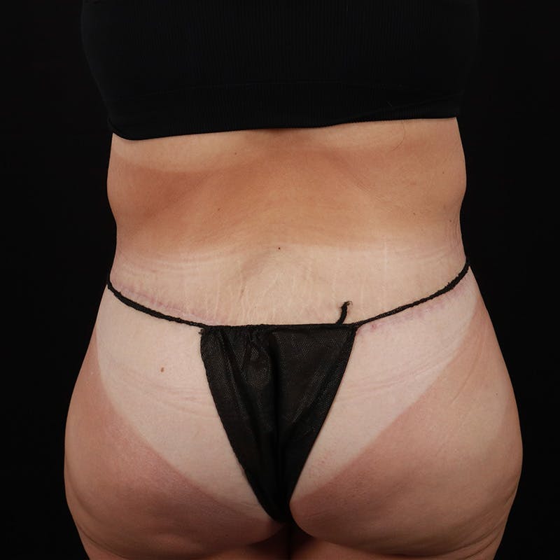 Body Lift Before & After Gallery - Patient 172844959 - Image 12