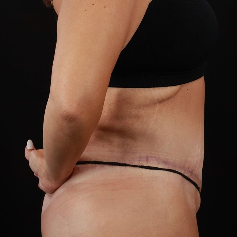 Body Lift Before & After Gallery - Patient 172844959 - Image 6