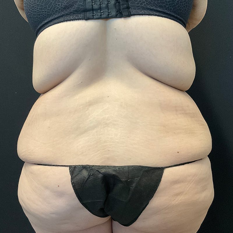 Body Lift Before & After Gallery - Patient 172844959 - Image 11