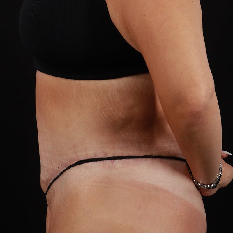 Body Lift Before & After Gallery - Patient 172844959 - Image 10