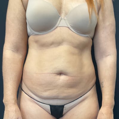 Abdominoplasty (Tummy Tuck) Before & After Gallery - Patient 172845071 - Image 1