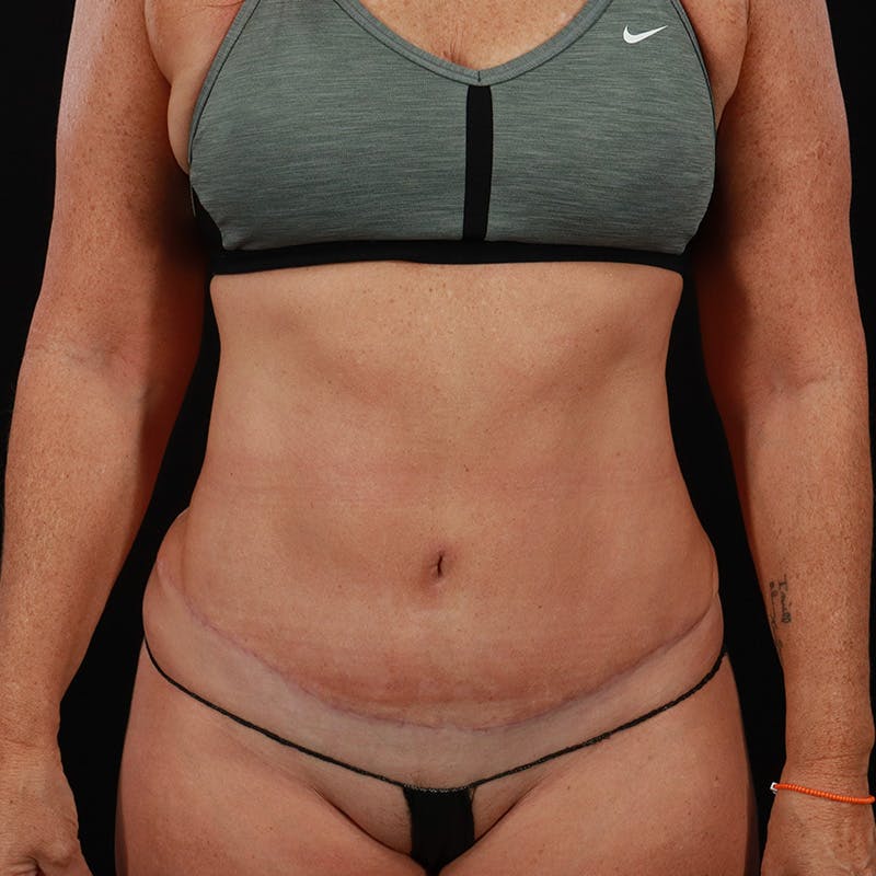 Abdominoplasty (Tummy Tuck) Before & After Gallery - Patient 172845071 - Image 2