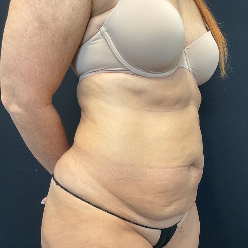 Abdominoplasty (Tummy Tuck) Before & After Gallery - Patient 172845071 - Image 3