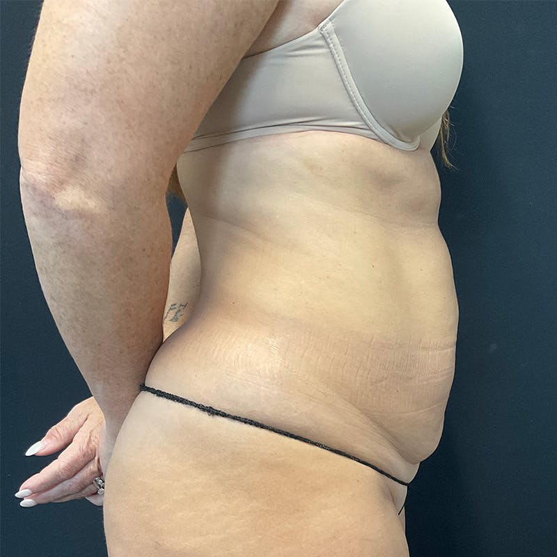 Abdominoplasty (Tummy Tuck) Before & After Gallery - Patient 172845071 - Image 5