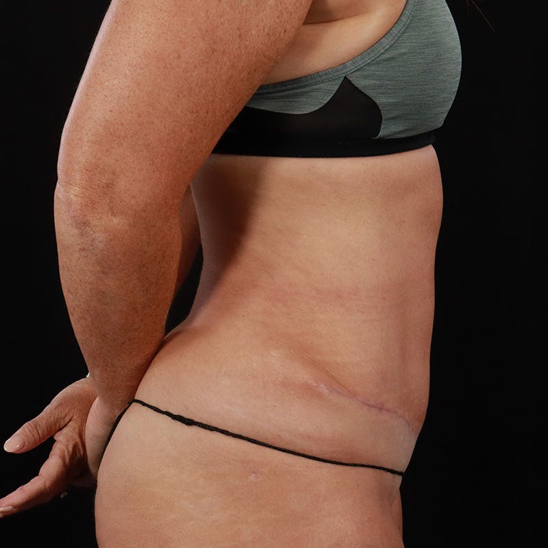 Abdominoplasty (Tummy Tuck) Before & After Gallery - Patient 172845071 - Image 6