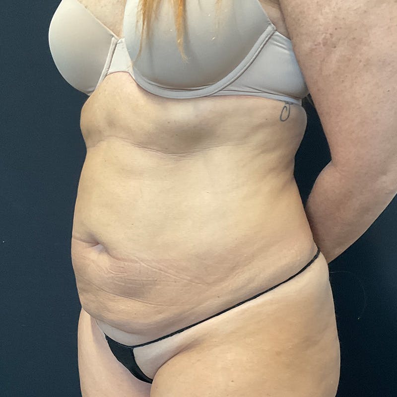Abdominoplasty (Tummy Tuck) Before & After Gallery - Patient 172845071 - Image 7